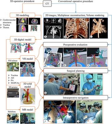 A Novel 3D Visualized Operative Procedure in the Single-Stage Complete Repair With Unifocalization of Pulmonary Atresia With Ventricular Septal Defect and Major Aortopulmonary Collateral Arteries